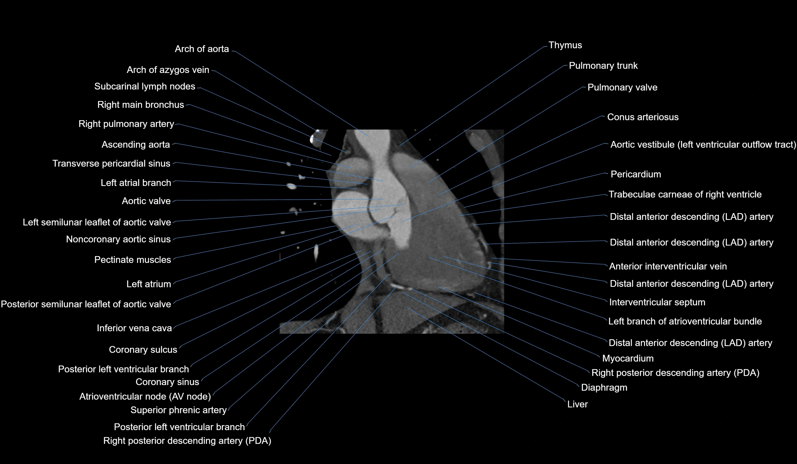 CT heart (coronary angiogram) 2 chamber view cross sectional anatomy labelled radiology image-00022.webp